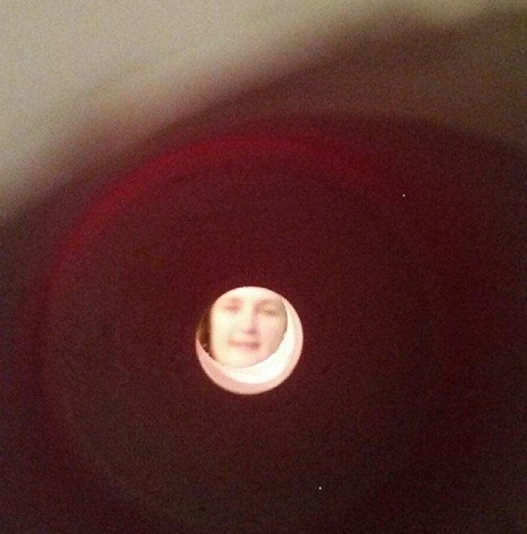trapped in a stoma3